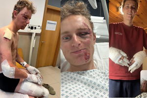 Lidl-Trek rider Philipsen mummified in bandages after an 80kph crash