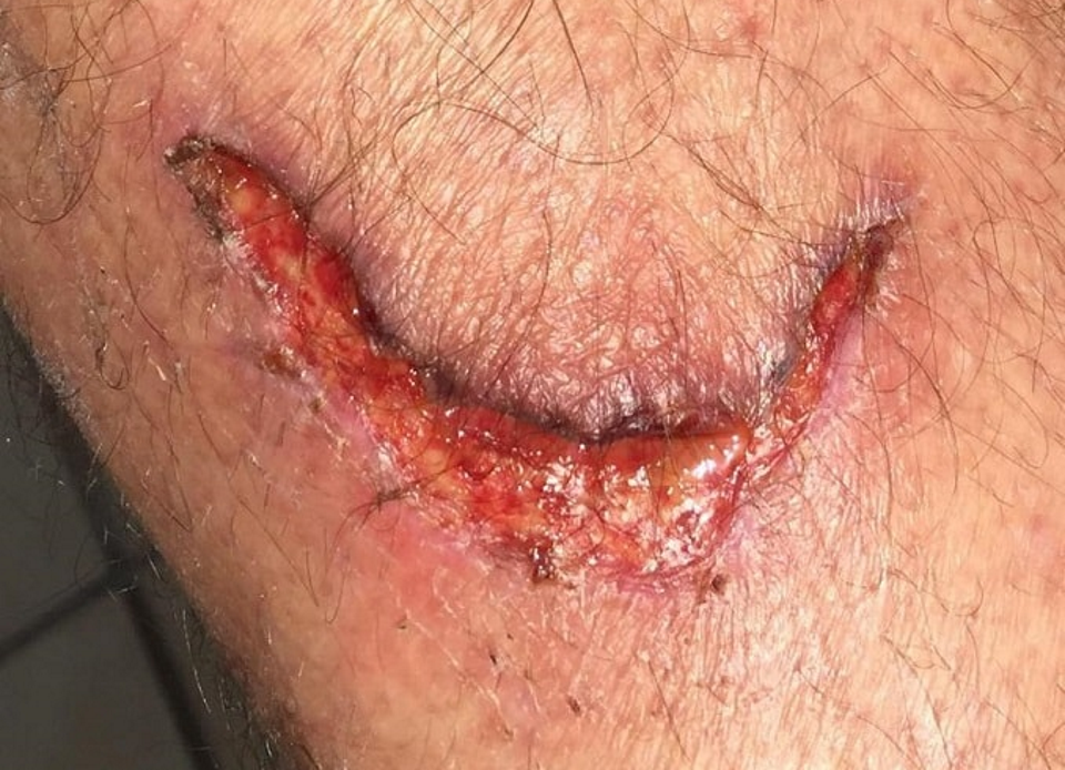 Peter Curtis-Brown contacted us and shared photos of his injury which is still an open wound almost two weeks later.