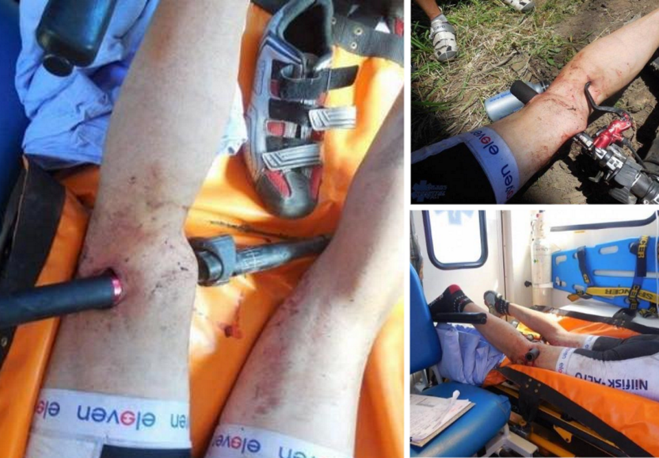 Cyclist suffers unbelievable injuries from handlebars